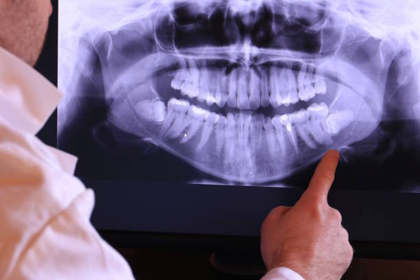Best Knocked-Out Tooth (Avulsed Tooth) Treatment in Fayetteville, TN